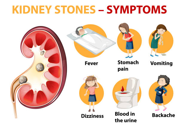 Kidney Stone Symptoms and Prevention Tips